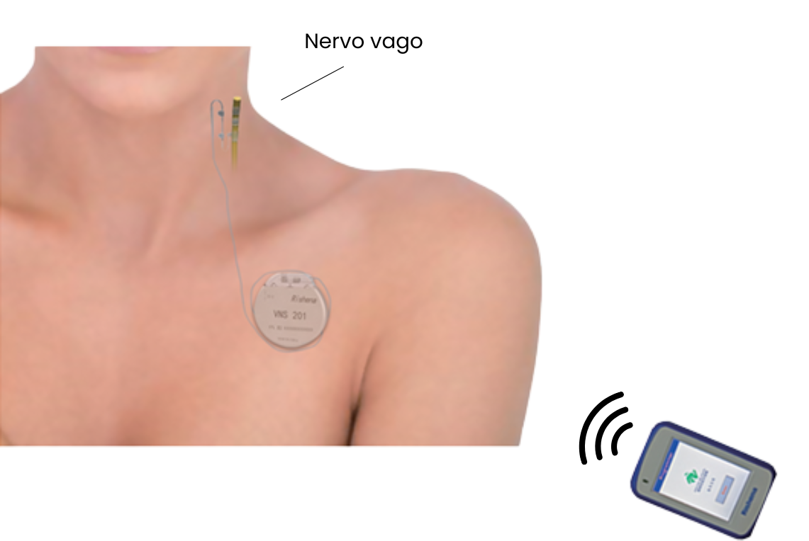 Sistema VNS – Estimulação do nervo vago - Imagem 3